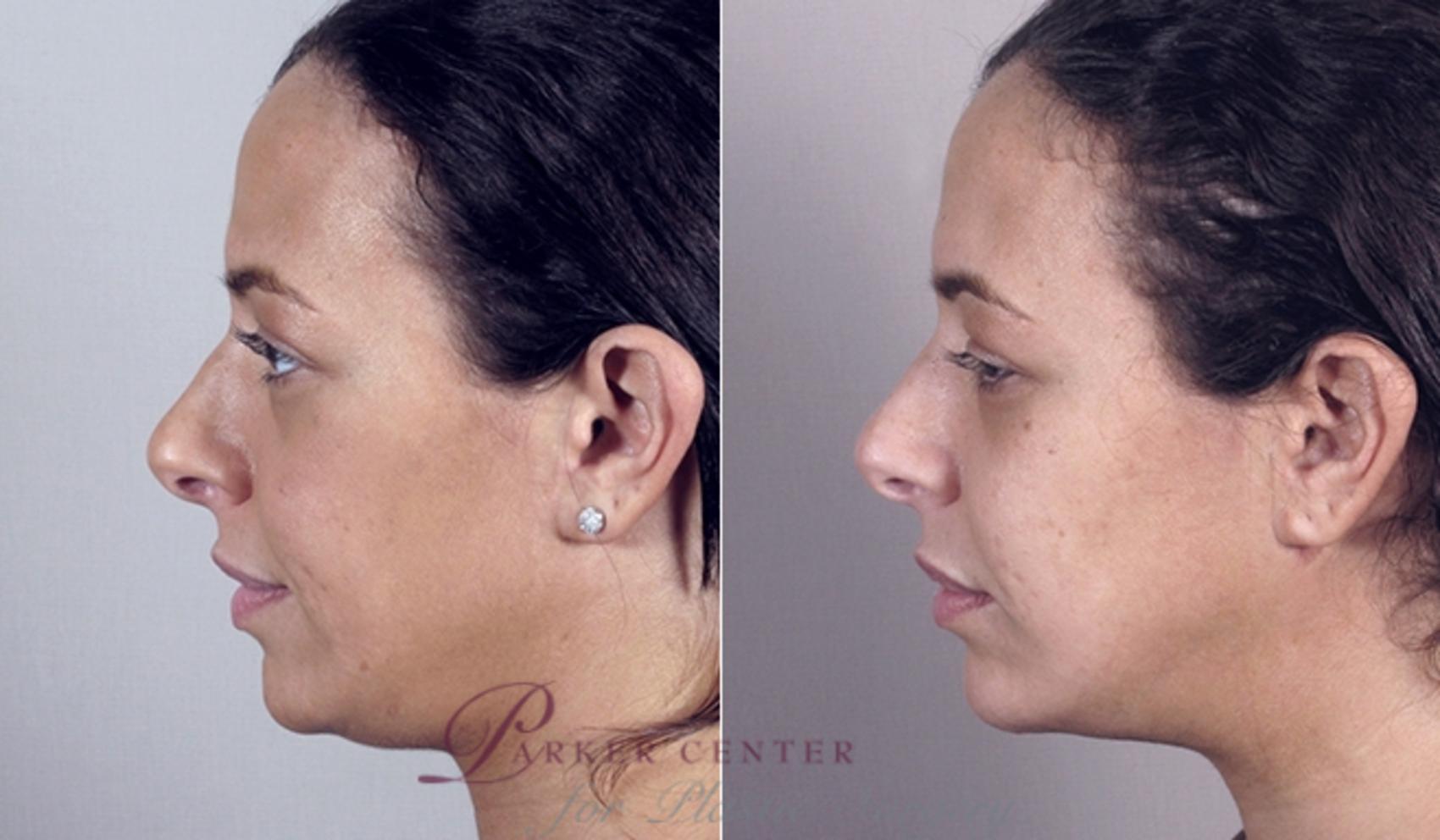 Face Case 863 Before & After View #2 | Paramus, NJ | Parker Center for Plastic Surgery