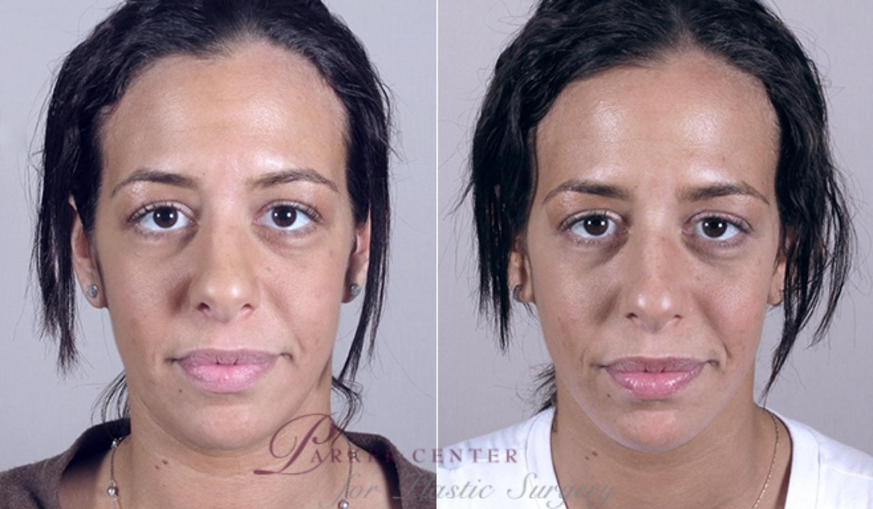 Face Case 863 Before & After View #3 | Paramus, NJ | Parker Center for Plastic Surgery