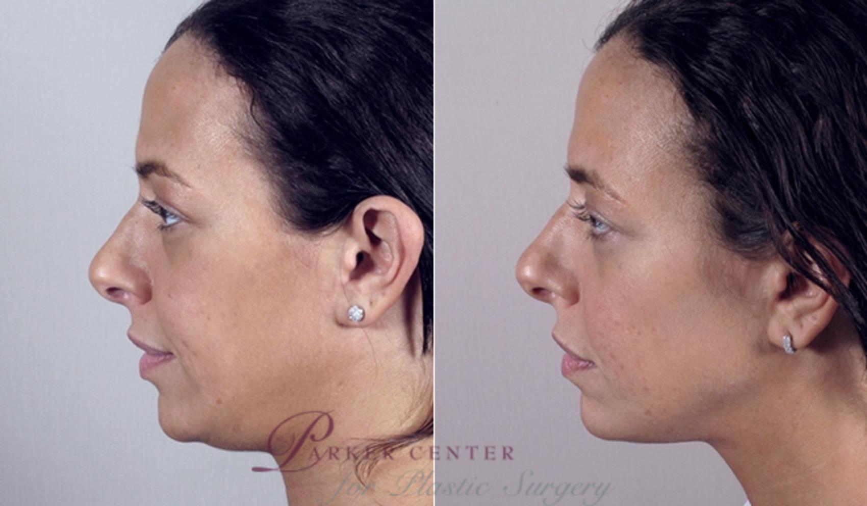 Face Case 863 Before & After View #4 | Paramus, NJ | Parker Center for Plastic Surgery