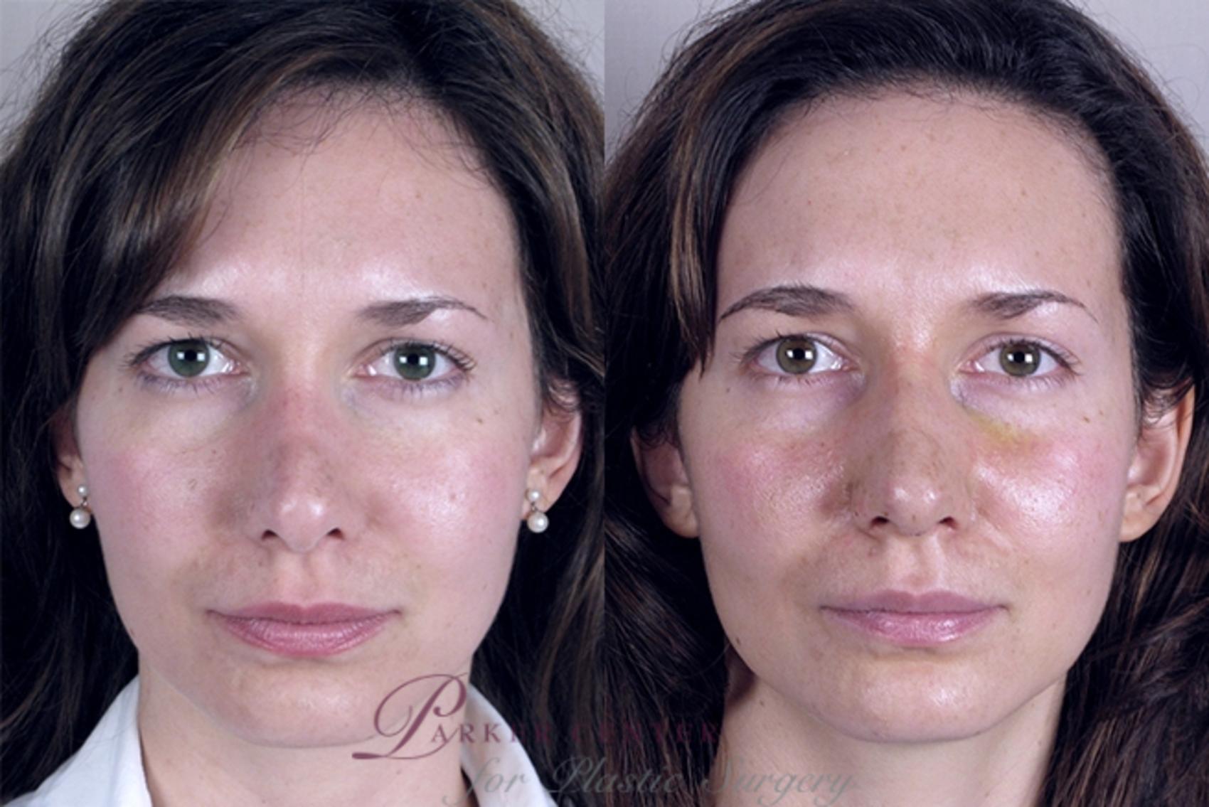 Face Case 864 Before & After View #1 | Paramus, NJ | Parker Center for Plastic Surgery