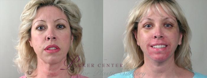Face Case 865 Before & After View #1 | Paramus, NJ | Parker Center for Plastic Surgery