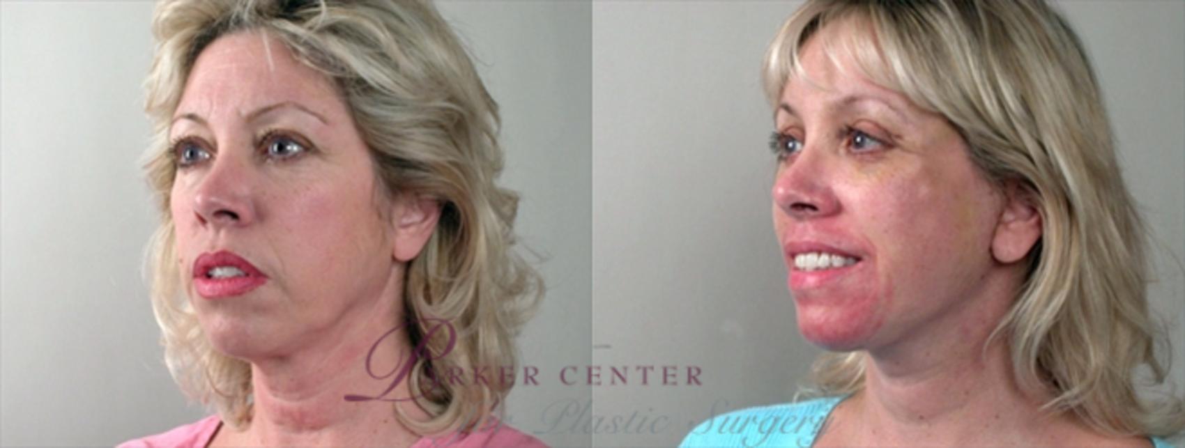 Face Case 865 Before & After View #2 | Paramus, NJ | Parker Center for Plastic Surgery