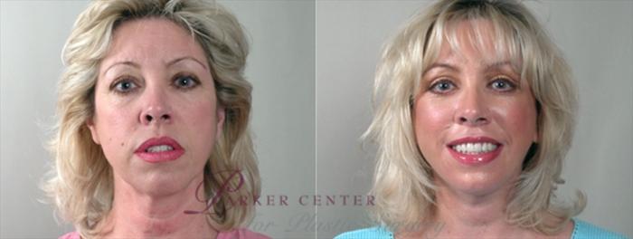 Face Case 865 Before & After View #3 | Paramus, NJ | Parker Center for Plastic Surgery