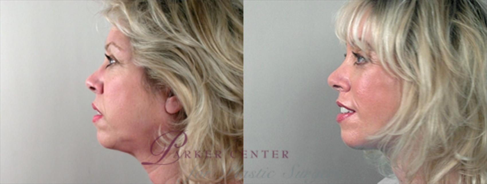 Face Case 865 Before & After View #4 | Paramus, NJ | Parker Center for Plastic Surgery