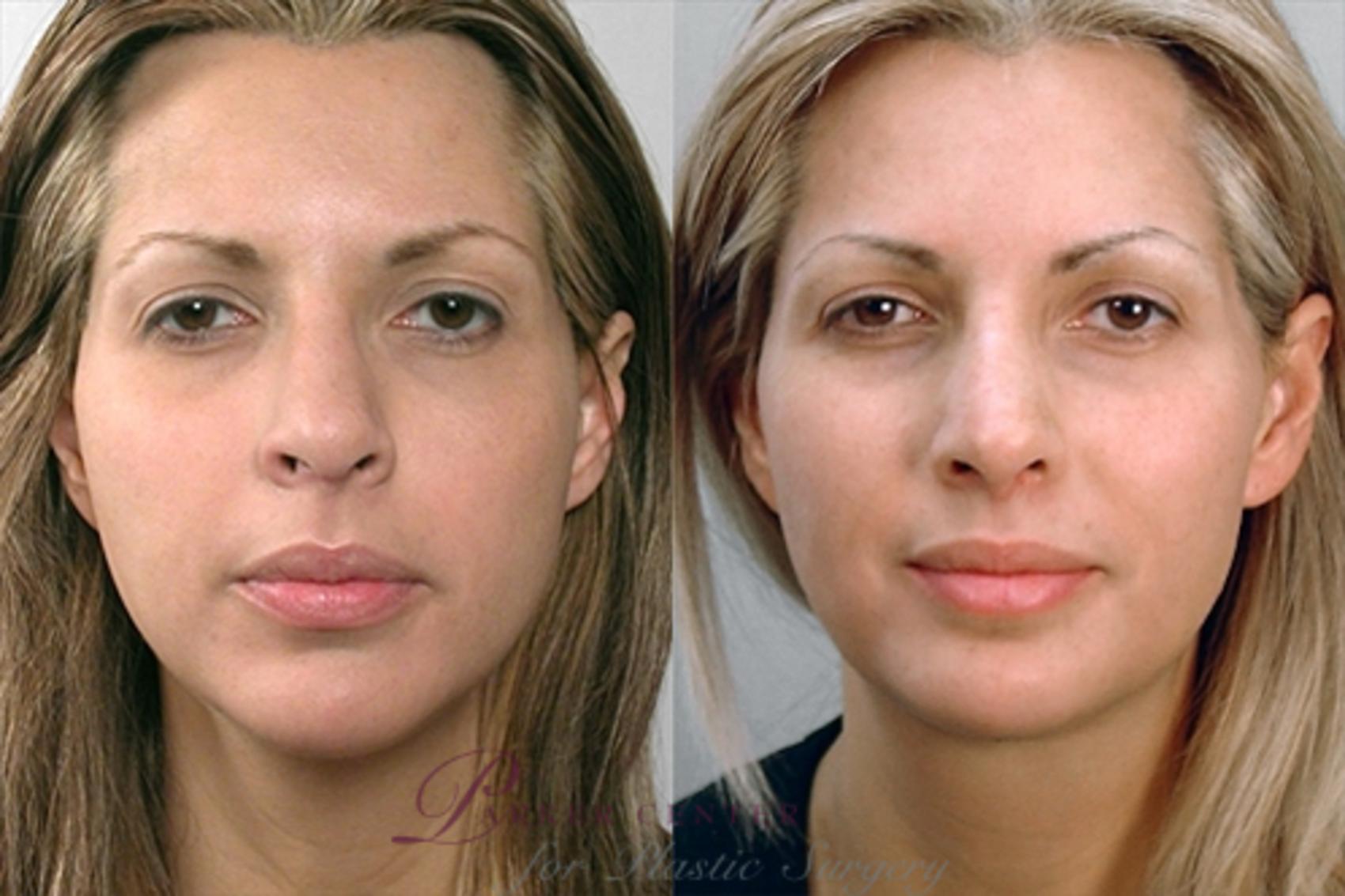 Face Case 866 Before & After View #1 | Paramus, NJ | Parker Center for Plastic Surgery