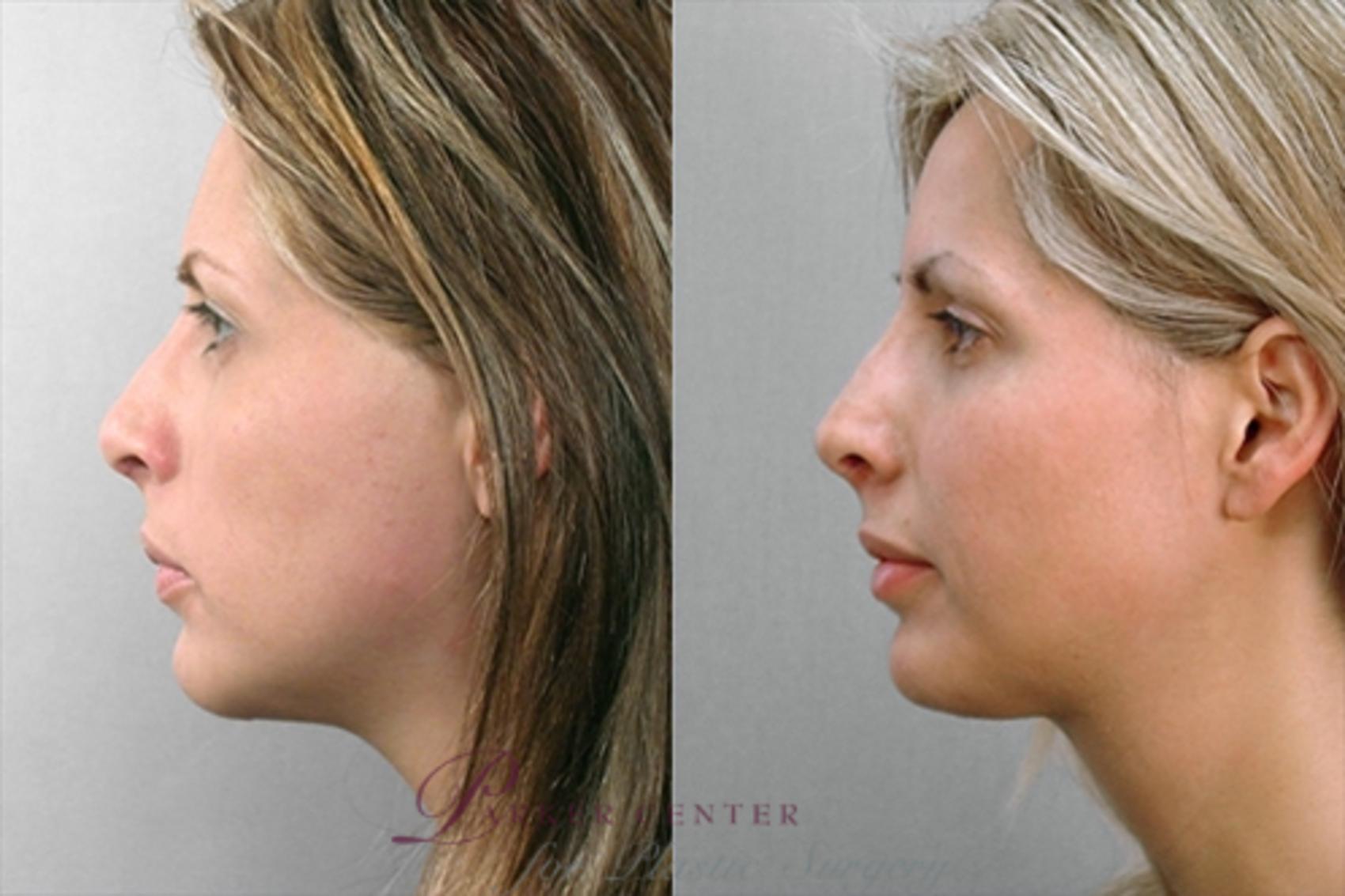 Face Case 866 Before & After View #2 | Paramus, NJ | Parker Center for Plastic Surgery