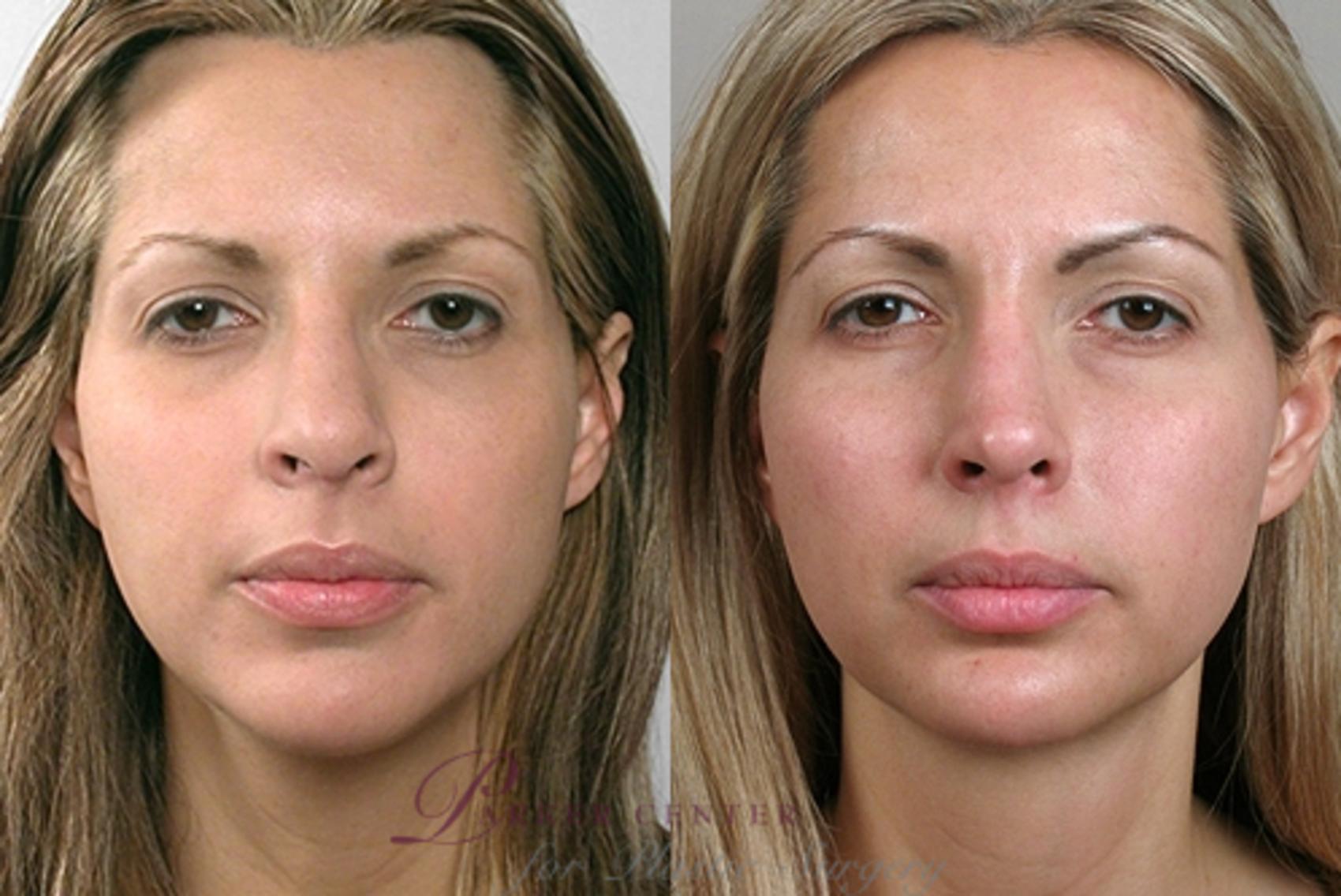 Face Case 866 Before & After View #3 | Paramus, NJ | Parker Center for Plastic Surgery