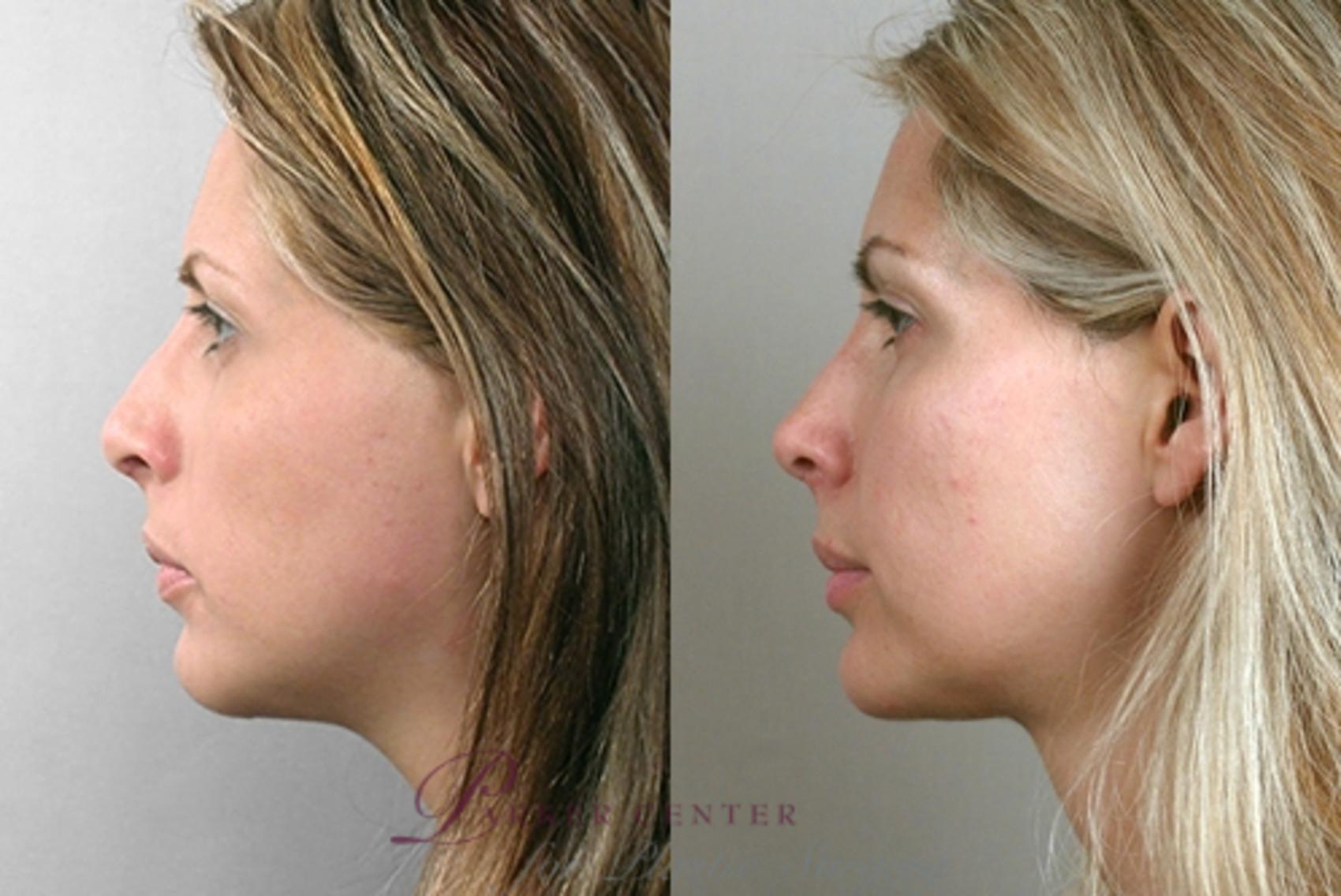 Face Case 866 Before & After View #4 | Paramus, NJ | Parker Center for Plastic Surgery
