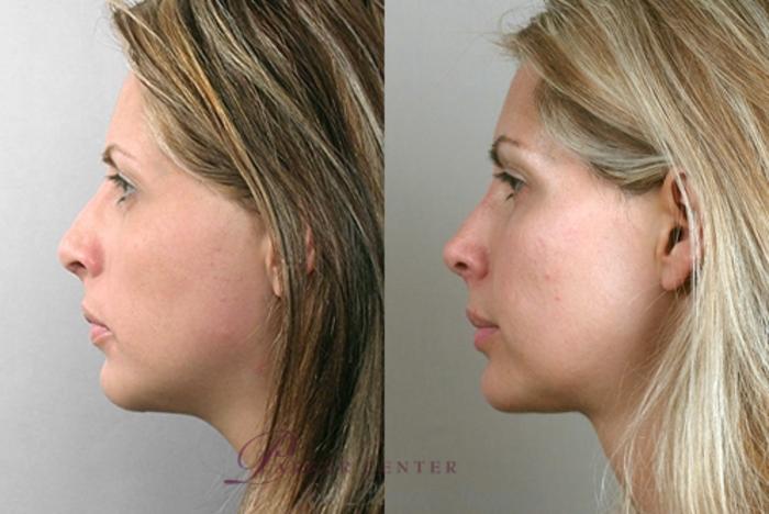 Face Case 866 Before & After View #4 | Paramus, NJ | Parker Center for Plastic Surgery
