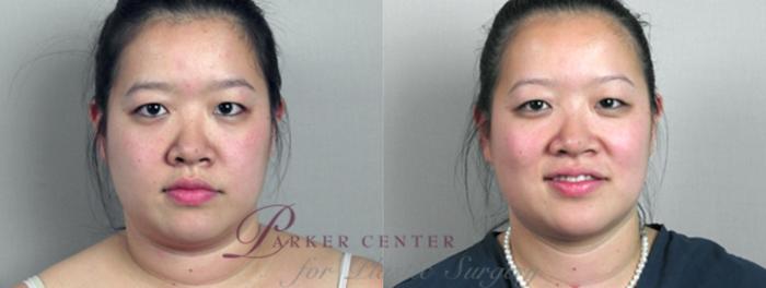 Face Case 867 Before & After View #1 | Paramus, NJ | Parker Center for Plastic Surgery