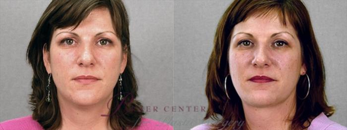 Face Case 868 Before & After View #1 | Paramus, NJ | Parker Center for Plastic Surgery