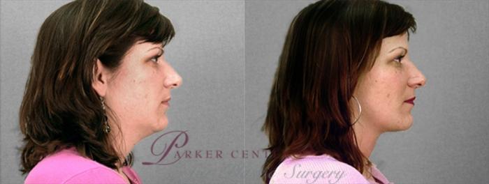 Face Case 868 Before & After View #2 | Paramus, NJ | Parker Center for Plastic Surgery