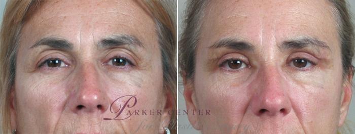 Face Case 869 Before & After View #1 | Paramus, NJ | Parker Center for Plastic Surgery