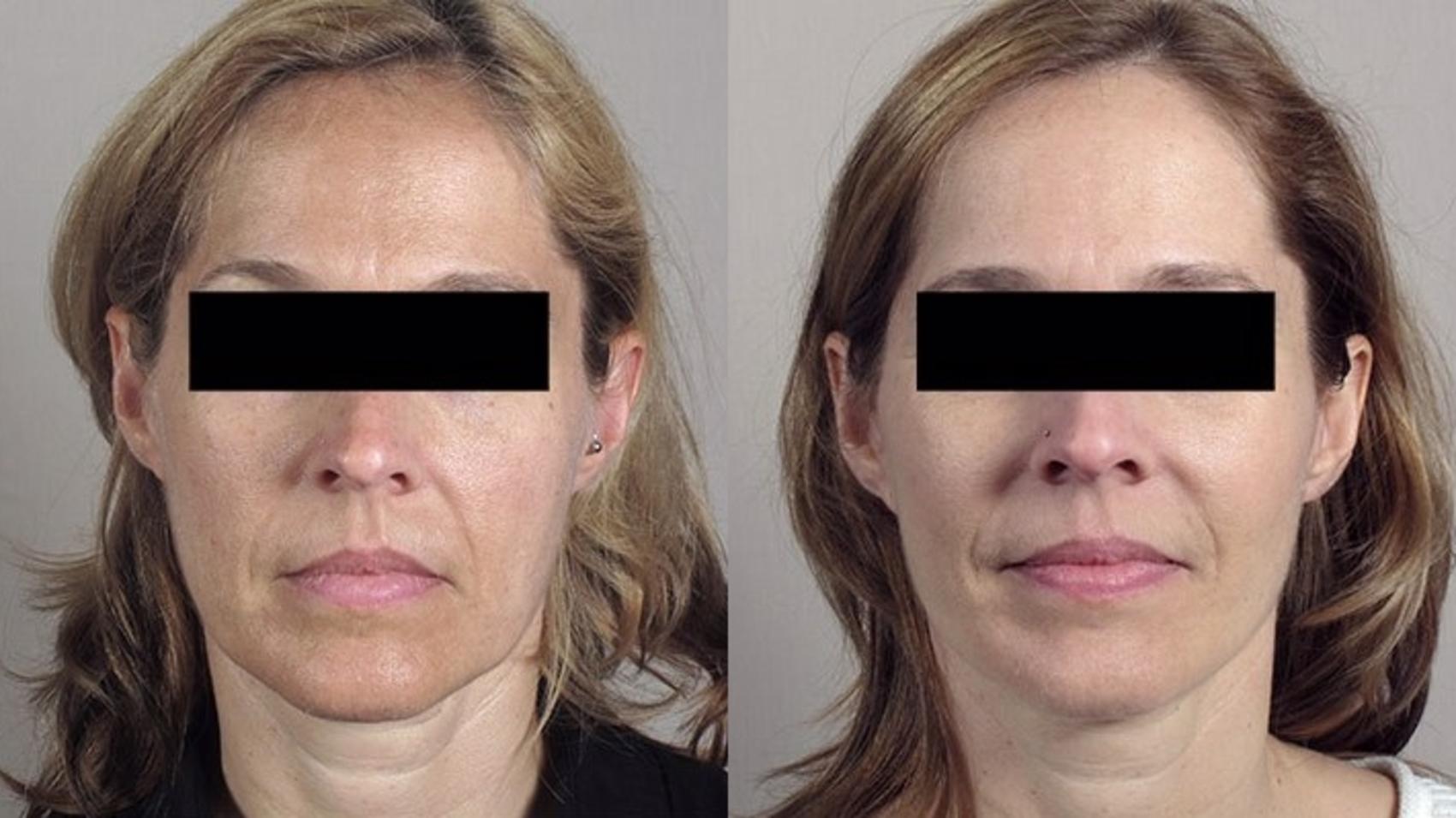 Facelift Case 1 Before & After View #2 | Paramus, New Jersey | Parker Center for Plastic Surgery