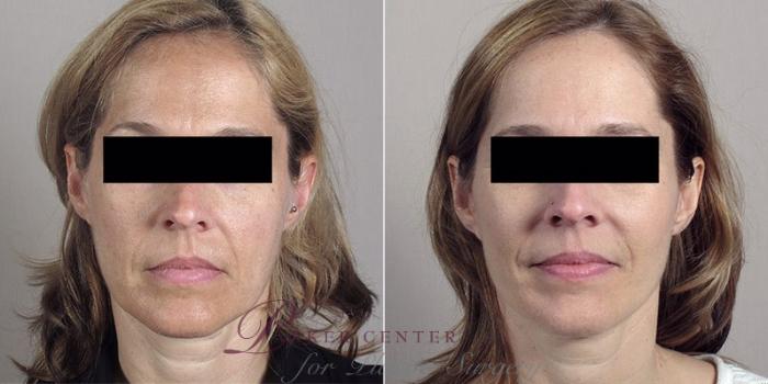 Facelift Case 1 Before & After View #2 | Paramus, NJ | Parker Center for Plastic Surgery