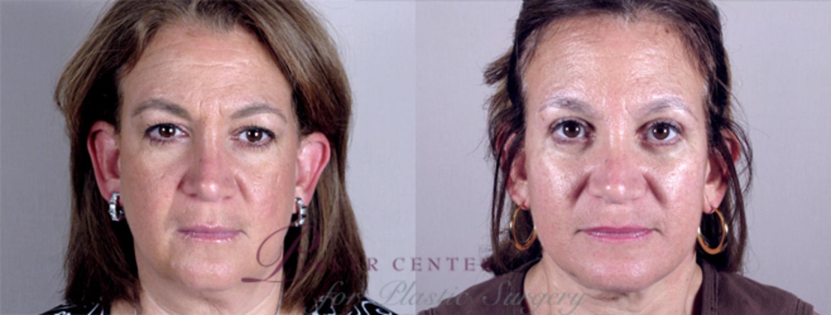 Eyelid Lift Case 11 Before & After View #1 | Paramus, NJ | Parker Center for Plastic Surgery