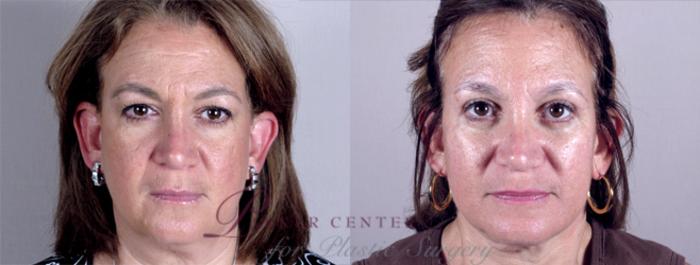 Facelift Case 11 Before & After View #1 | Paramus, NJ | Parker Center for Plastic Surgery