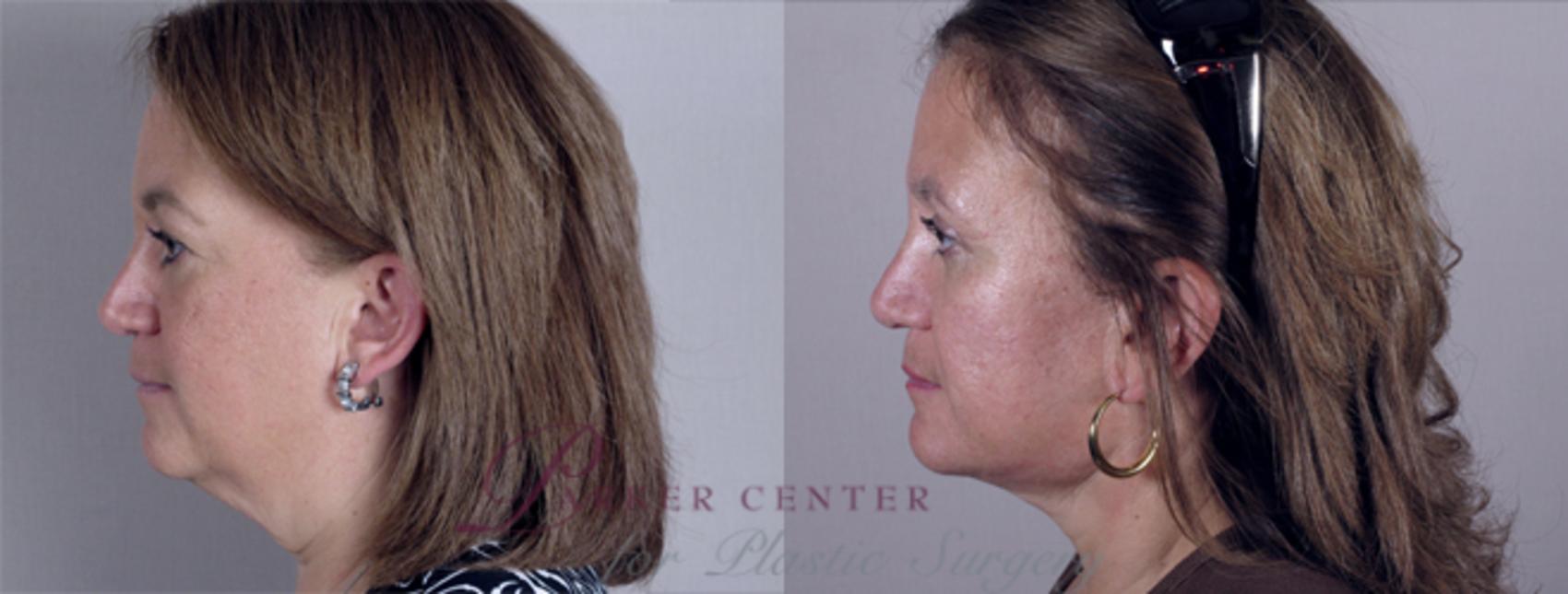 Eyelid Lift Case 11 Before & After View #2 | Paramus, NJ | Parker Center for Plastic Surgery