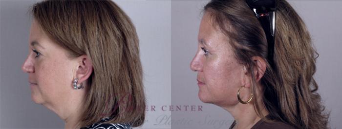 Facelift Case 11 Before & After View #2 | Paramus, NJ | Parker Center for Plastic Surgery