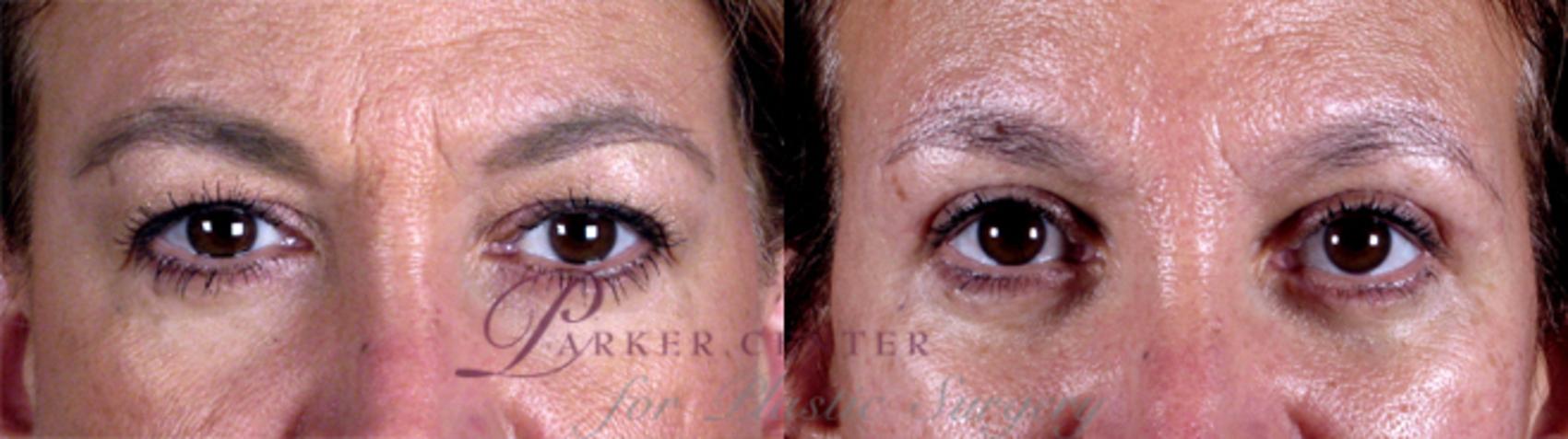 Eyelid Lift Case 11 Before & After View #3 | Paramus, NJ | Parker Center for Plastic Surgery