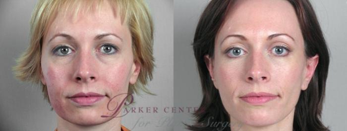 Facelift Case 1172 Before & After View 1  | Paramus, NJ | Parker Center for Plastic Surgery