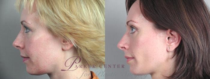 Facelift Case 1172 Before & After View 3 | Paramus, NJ | Parker Center for Plastic Surgery