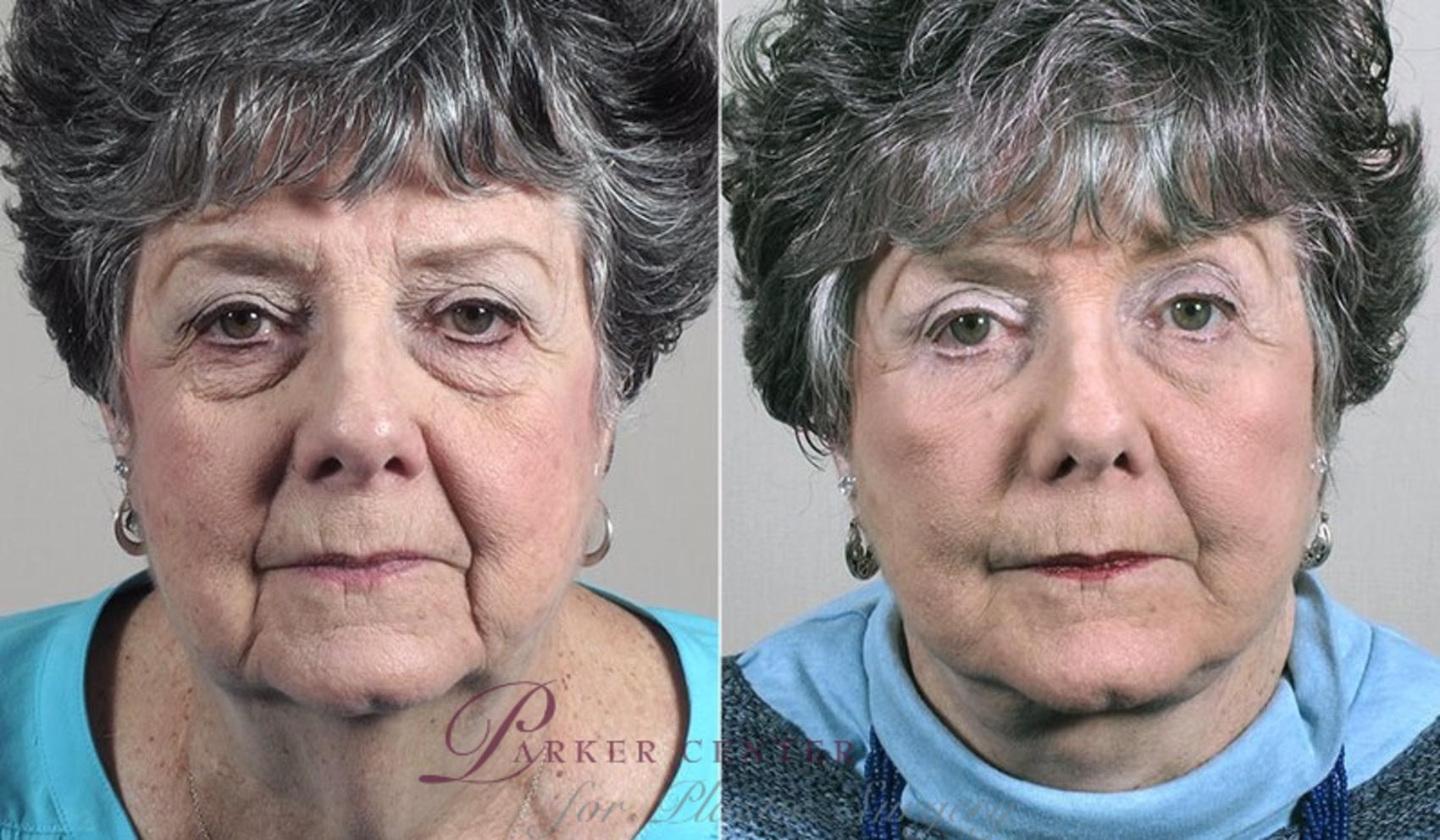 Facelift Case 1178 Before & After View 1  | Paramus, NJ | Parker Center for Plastic Surgery