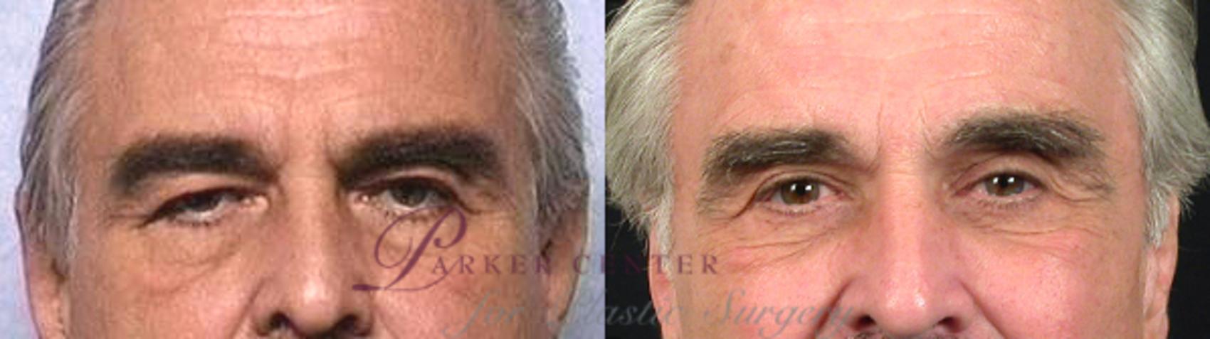 Eyelid Lift Case 12 Before & After View #3 | Paramus, NJ | Parker Center for Plastic Surgery