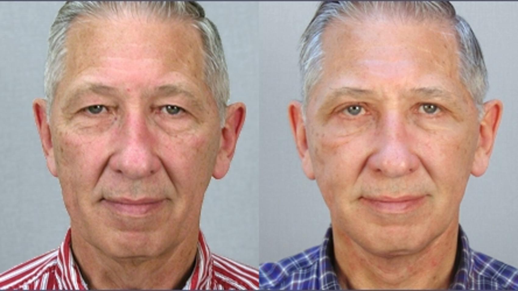 Facelift Case 13 Before & After View #1 | Paramus, New Jersey | Parker Center for Plastic Surgery