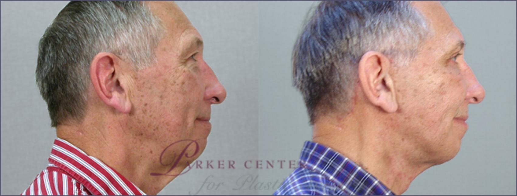 Facelift Case 13 Before & After View #2 | Paramus, NJ | Parker Center for Plastic Surgery