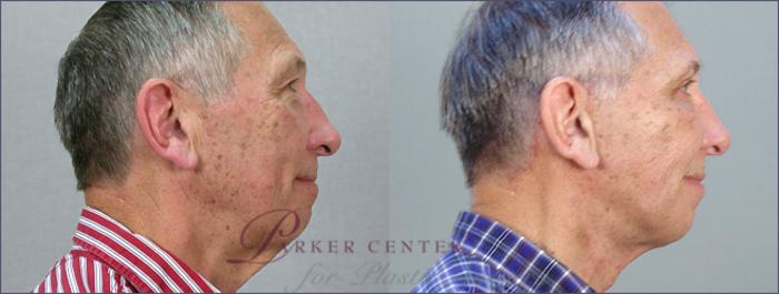 Neck Contouring Case 13 Before & After View #2 | Paramus, NJ | Parker Center for Plastic Surgery