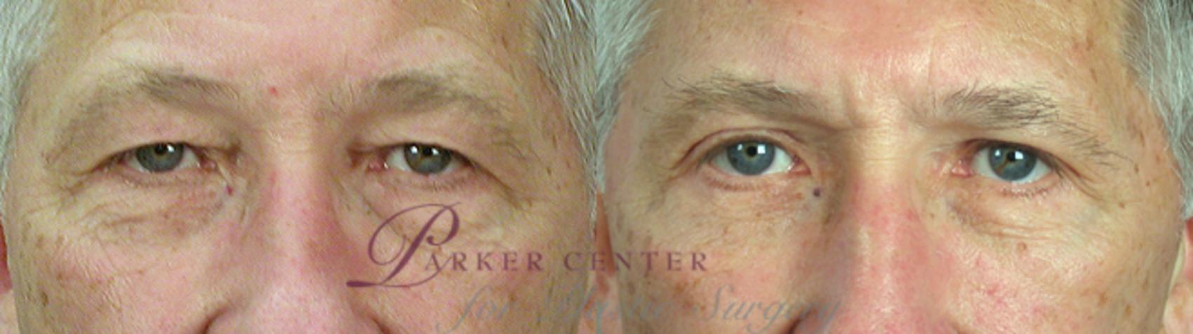 Facelift Case 13 Before & After View #3 | Paramus, NJ | Parker Center for Plastic Surgery