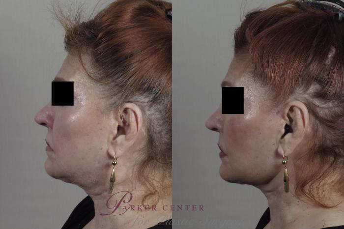 Facelift Case 1345 Before & After Left Side | Paramus, NJ | Parker Center for Plastic Surgery
