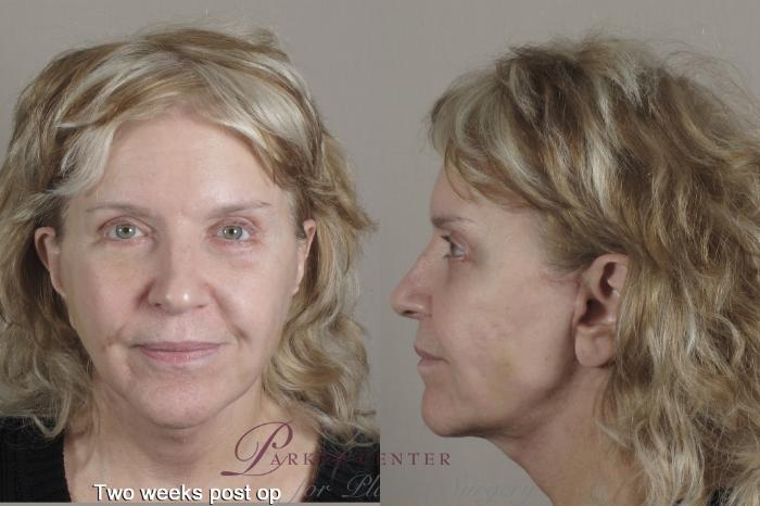 Facelift Case 1347 Before & After 2 weeks  | Paramus, New Jersey | Parker Center for Plastic Surgery
