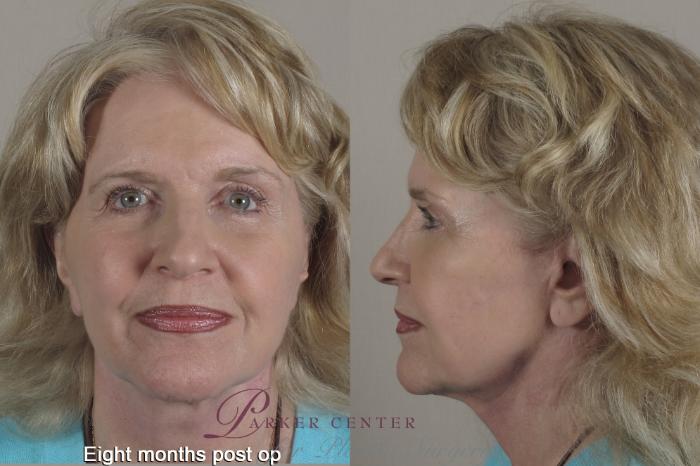 Facelift Case 1347 Before & After 8 months  | Paramus, New Jersey | Parker Center for Plastic Surgery