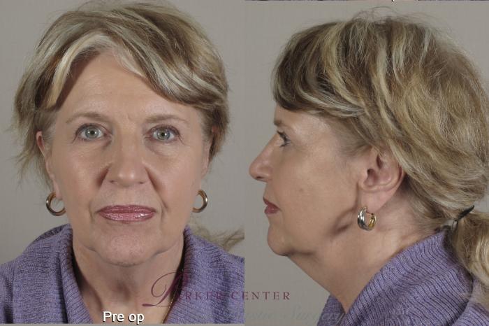 Facelift Case 1347 Before & After Front | Paramus, New Jersey | Parker Center for Plastic Surgery