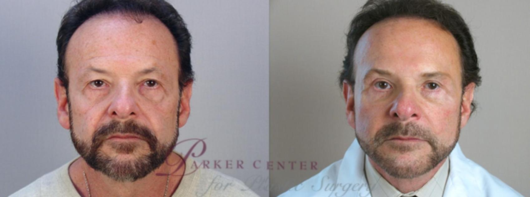 Facelift Case 1379 Before & After Front | Paramus, NJ | Parker Center for Plastic Surgery