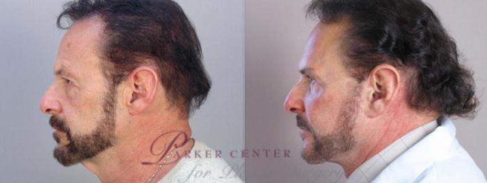 Facelift Case 1379 Before & After Left Side | Paramus, NJ | Parker Center for Plastic Surgery
