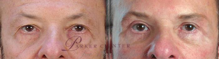 Facelift Case 1379 Before & After zoomed in  | Paramus, NJ | Parker Center for Plastic Surgery