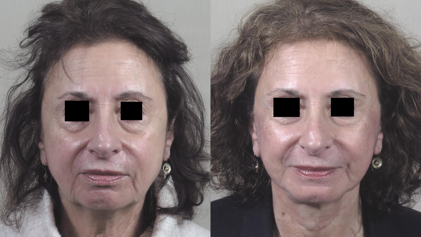 Facelift Case 1393 Before & After Front | Paramus, New Jersey | Parker Center for Plastic Surgery