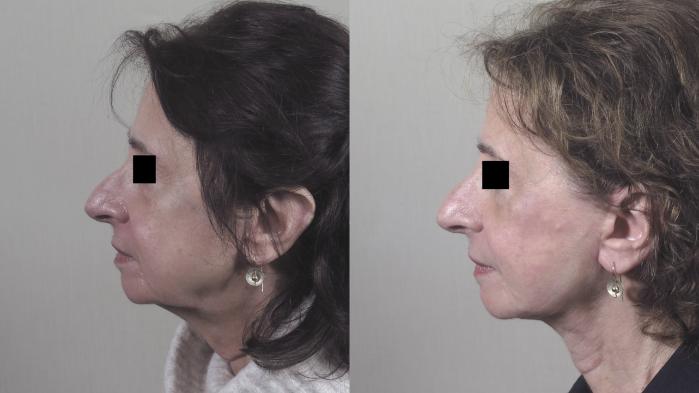 Facelift Case 1393 Before & After Side view | Paramus, New Jersey | Parker Center for Plastic Surgery