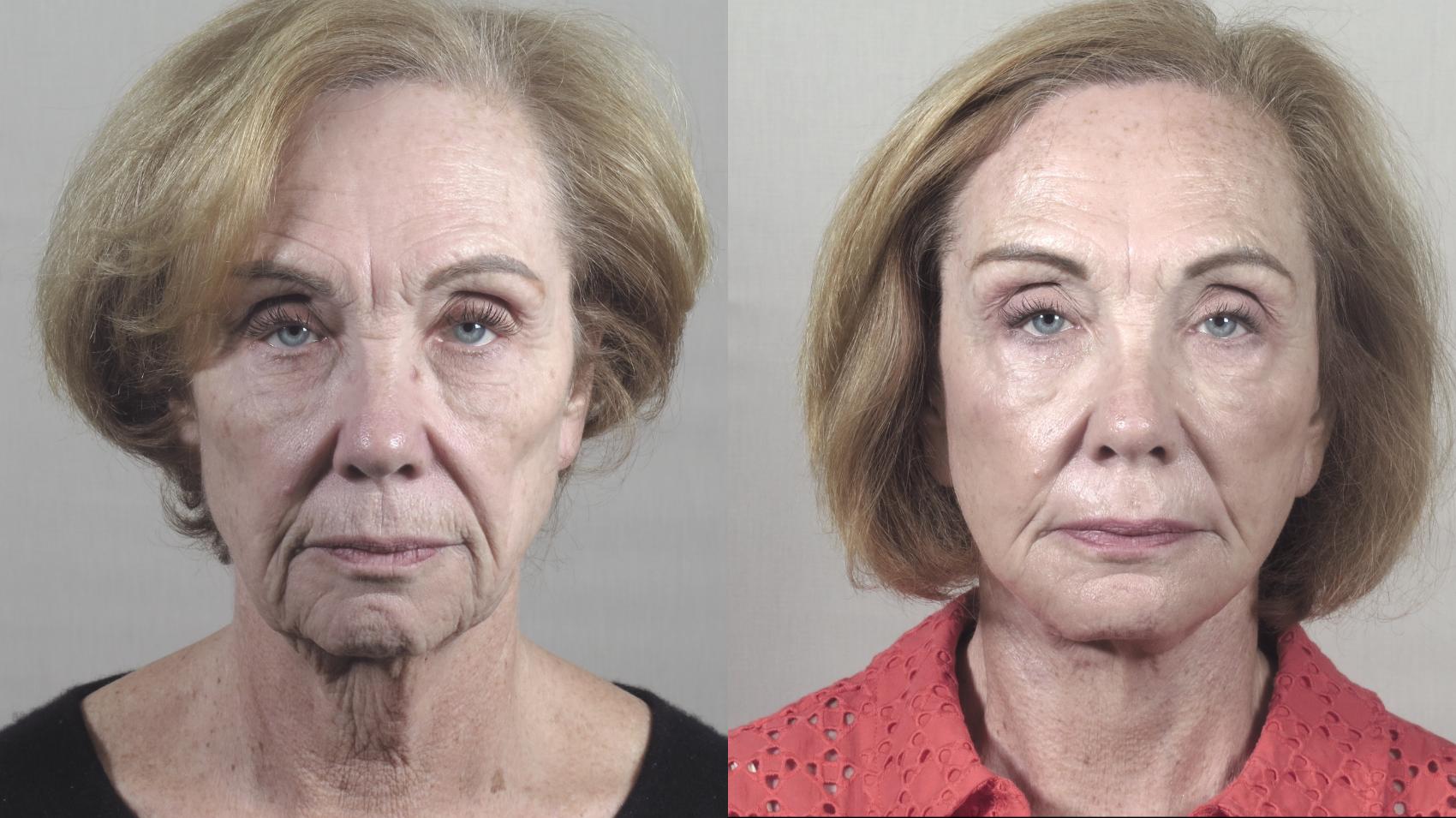 Facelift Case 1421 Before & After Front View | Paramus, New Jersey | Parker Center for Plastic Surgery