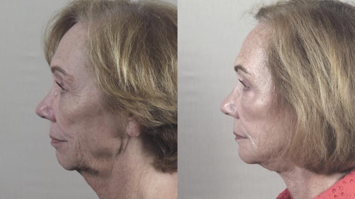 Facelift Case 1421 Before & After Left Side | Paramus, New Jersey | Parker Center for Plastic Surgery