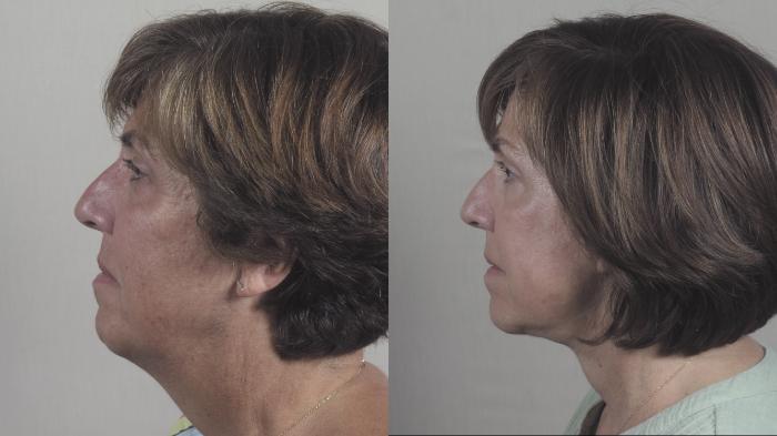 Facelift Case 1436 Before & After Left Side | Paramus, New Jersey | Parker Center for Plastic Surgery