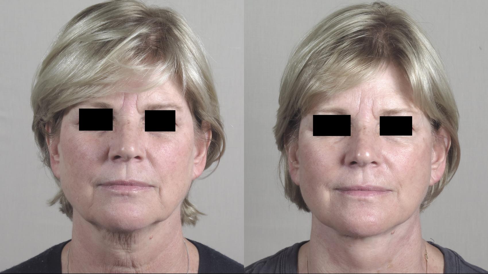 Facelift Case 1438 Before & After Front | Paramus, New Jersey | Parker Center for Plastic Surgery