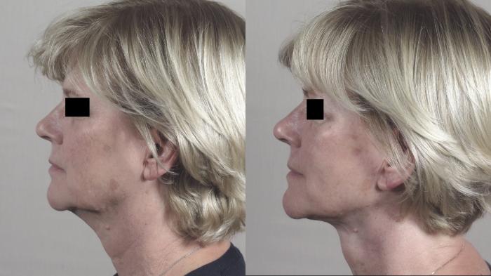 Facelift Case 1438 Before & After Left Side | Paramus, New Jersey | Parker Center for Plastic Surgery