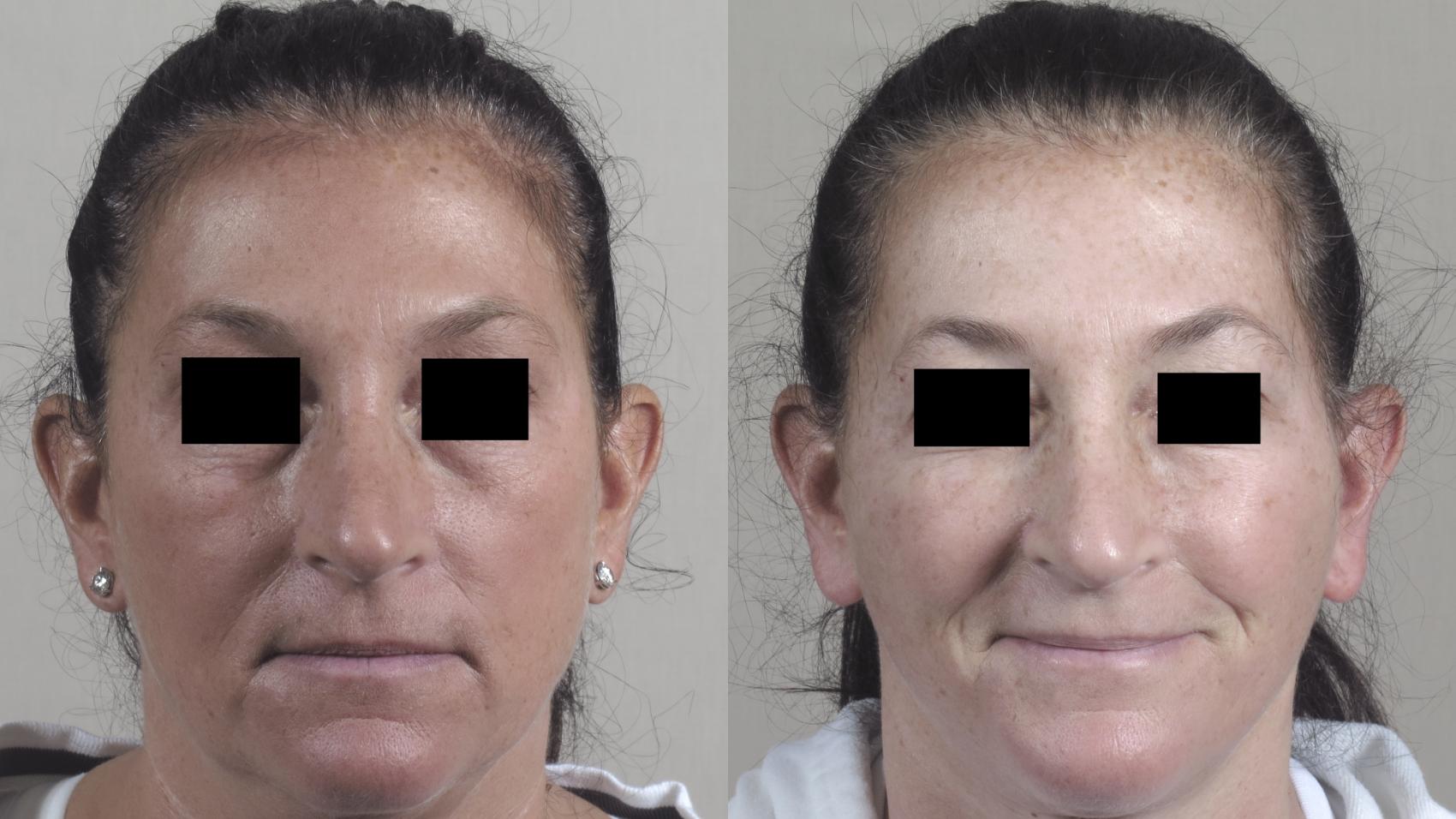 Facelift Case 1439 Before & After Front | Paramus, New Jersey | Parker Center for Plastic Surgery