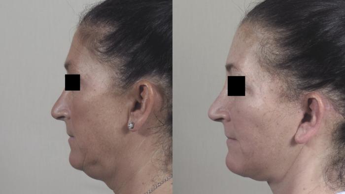 Facelift Case 1439 Before & After Left Side | Paramus, New Jersey | Parker Center for Plastic Surgery