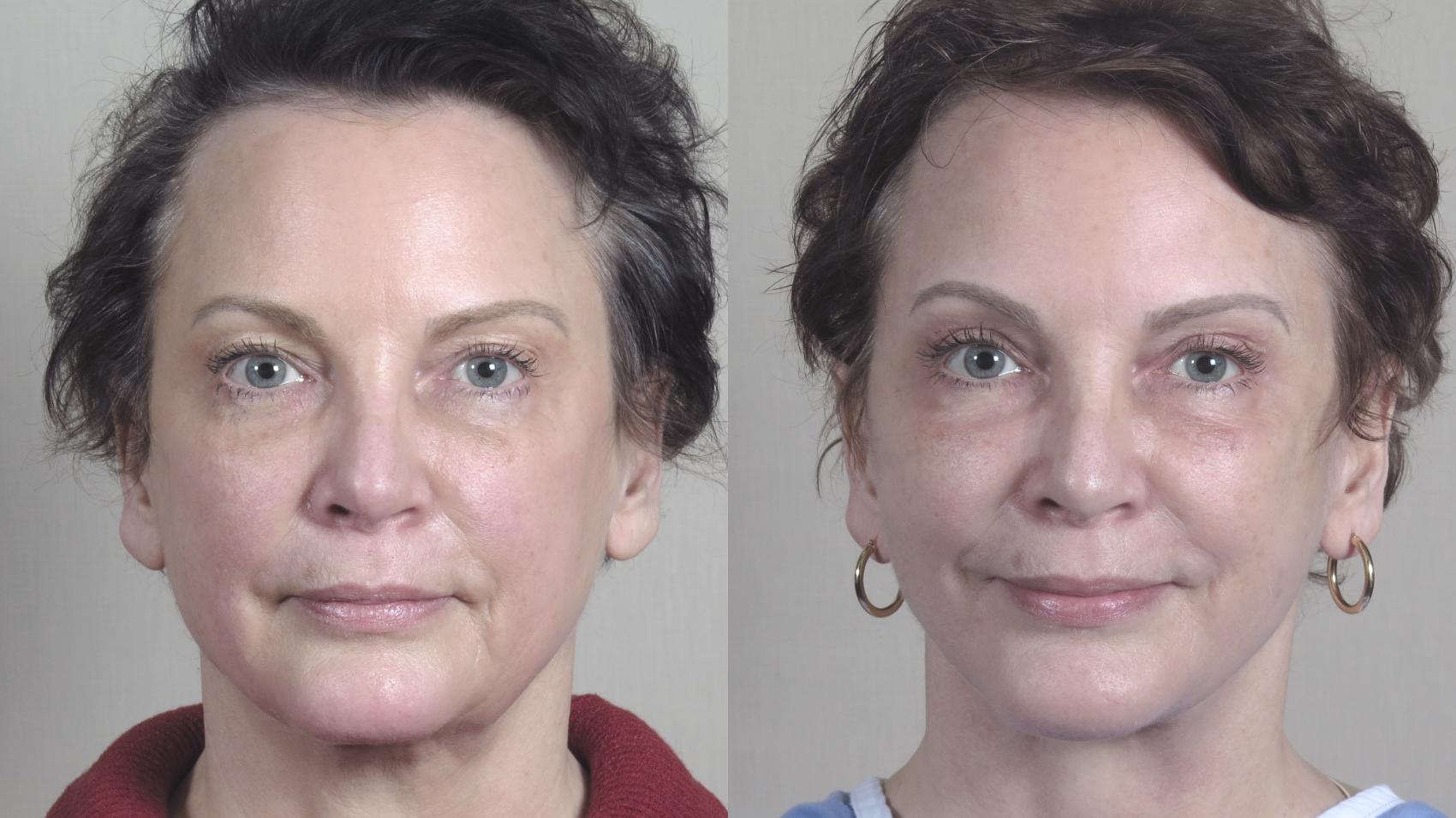 Facelift Case 1468 Before & After Front | Paramus, New Jersey | Parker Center for Plastic Surgery