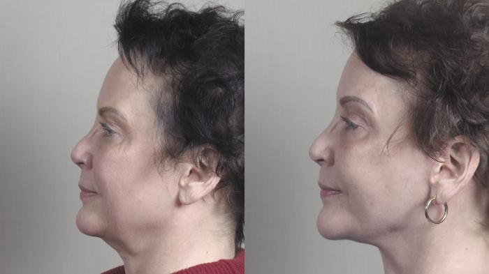 Facelift Case 1468 Before & After Left Side | Paramus, New Jersey | Parker Center for Plastic Surgery